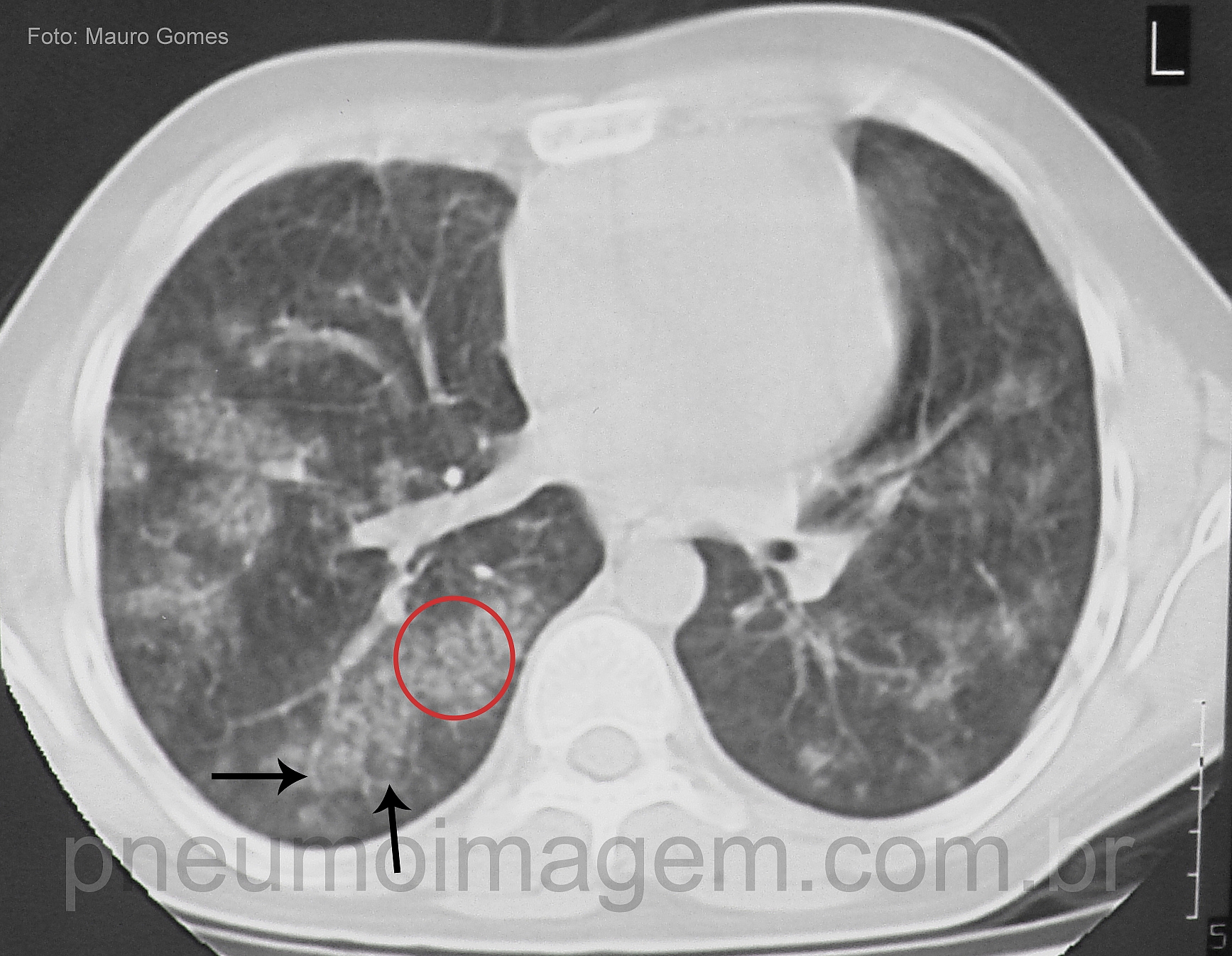 DESTAQUES DO ERS2016: HEMORRAGIA ALVEOLAR DIFUSA (HAD)